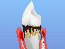 末期歯周炎